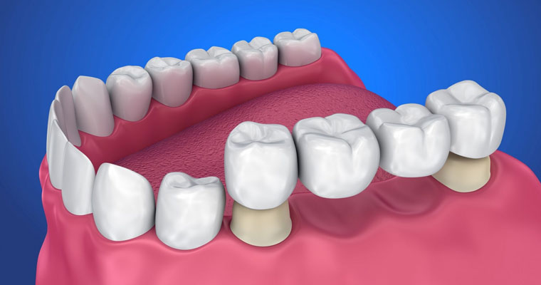 Dental-Bridges