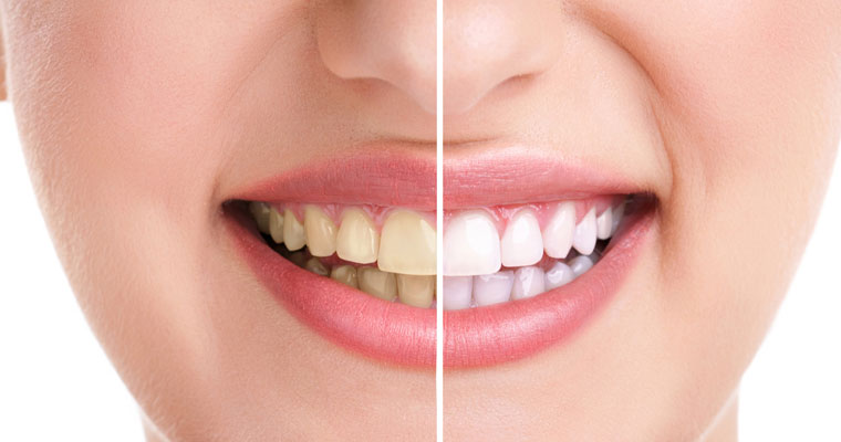 Teeth-Whitening