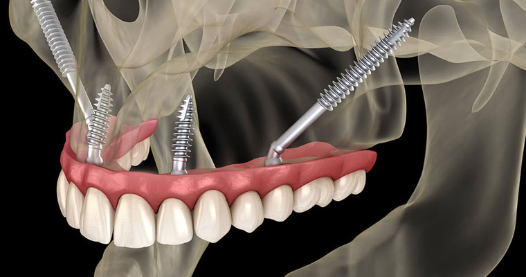 Zygomatic-Dental-Implants