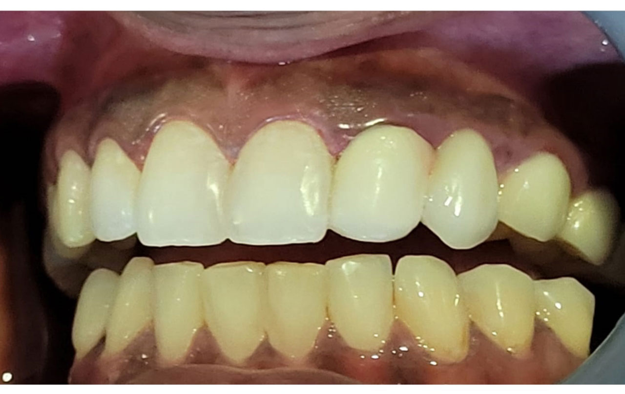 composite-fillings-1