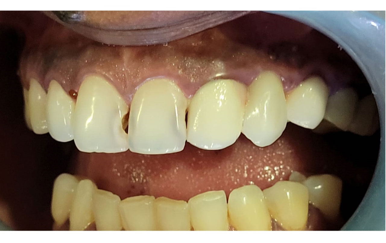 composite-fillings