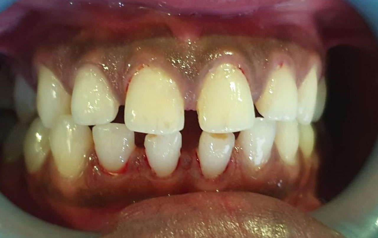 teeth-gap-closing-1