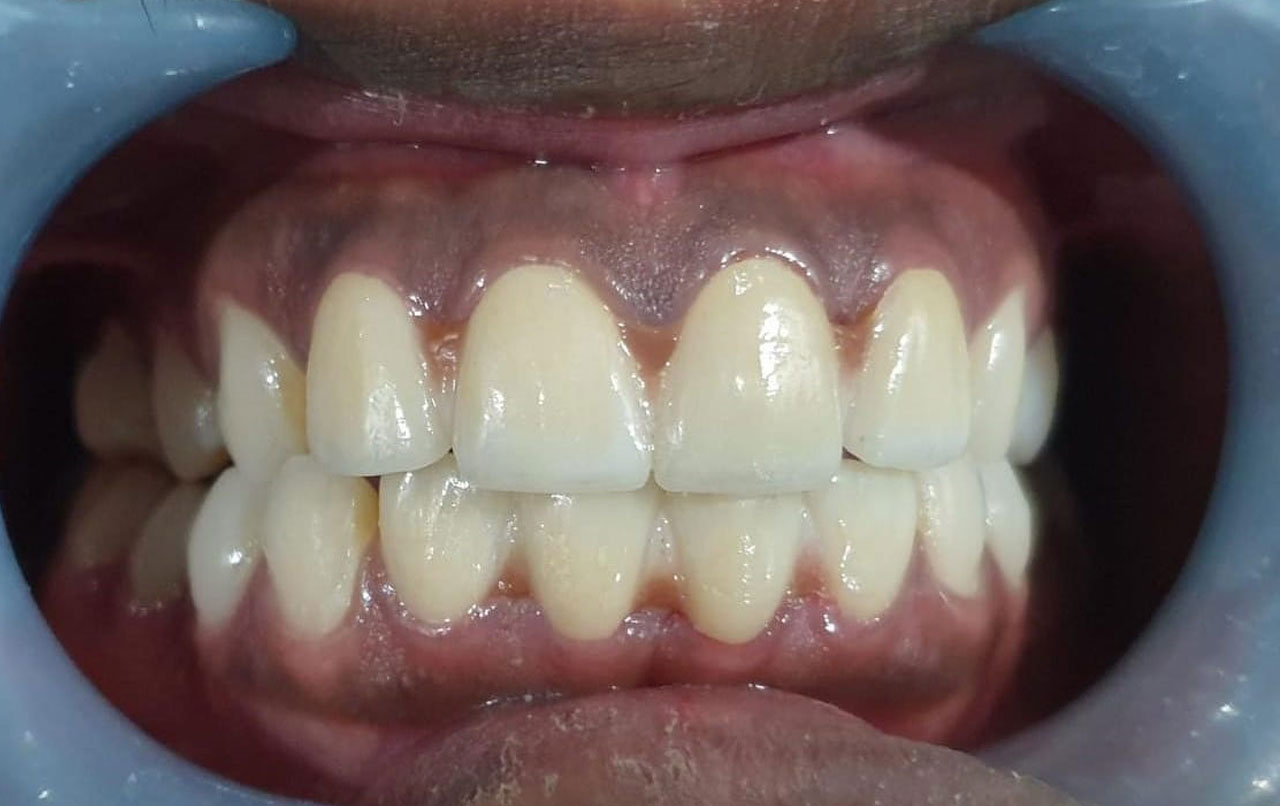 teeth-gap-closing-2